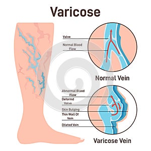 Varicoses. Anatomical diagram of varicose vein and normal healthy vein
