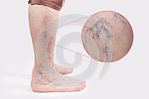 Varicosity. Close up side view of old feet of woman with vascular asterisks. Zoomed area with blood vessels. White