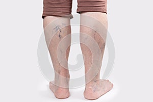 Varicosity. Close up view of old legs of woman with vascular asterisks. Back view. White background. The concept of