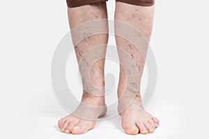 Varicosity and thrombosis. Close up of elderly feet of woman with vascular asterisks. White background. The concept of