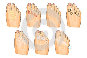 The various injuries of the feet. fungus, burning, warts, sweating. as well as soap, lotion, and spray