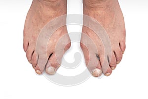 Varus valgus and Hallux valgus, bunion on white background.