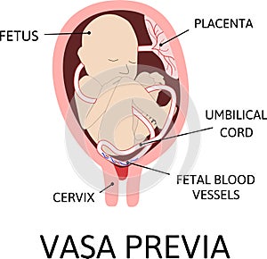 Vasa praevia is fetal blood vessels cross