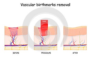 Vascular birthmarks removal