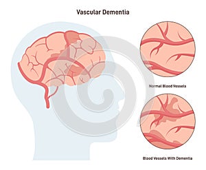 Vascular dementia. Common type of dementia caused by reduced blood photo