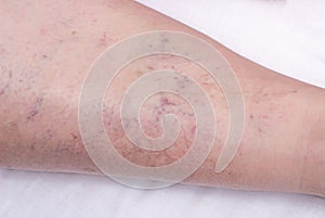 Vascular marks on the skin from varicose veins, vascular pattern on the skin, close-up, phlebeurysm, problem, white background