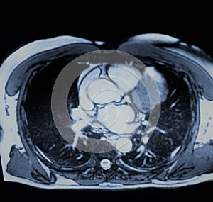 Vascular pathology ascending aorta aneurism mri photo