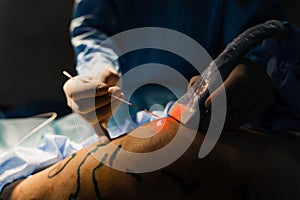 Vascular surgeon is operating leg using EVLT Red laser optical fiber for endovenous laser coagulation for treatment