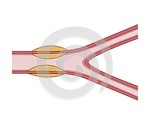 Vasculitis. Destroy Blood Vessels
