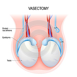Vasectomy. Open-ended method and ligating suturing.