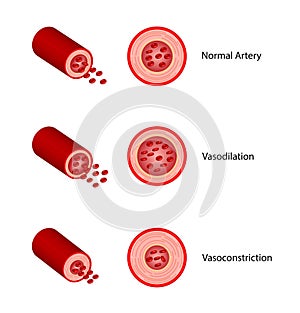 Arterial vasoconstriction and vasodilation. Comparison of normal, constricted, and dilated blood vessels. Vector illustration. photo