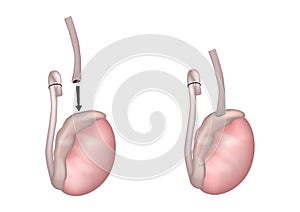 Vasoepididymostomy or epididymovasostomy surgical procedures. Vasoepididymostomy Anastomosis. Operation on the testicles photo