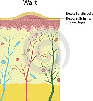 Vecro illustration structure of wart. Excess keratin cells. Excess cells in the spinous layer