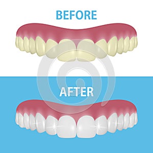 Vector Background with 3d Realistic Render Denture Set Closeup Isolated. Dentistry and Orthodontics Design. Human Teeth