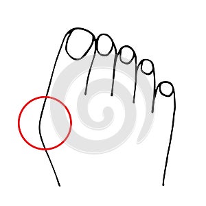Vector black outline drawing. Hallux valgus, deformity of the big toe, curvature of the plus phalangeal joint. Medicine and photo