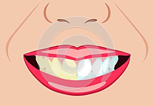 Vector face of girl and smile with bad and ideal teeth for dental and stomatological illustrations