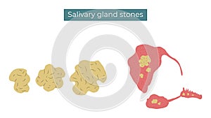 Stones in the parotid, submandibular and sublingual salivary glands photo