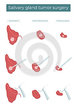 Surgical removal of a tumor from the parotid, submandibular, and sublingual salivary glands photo