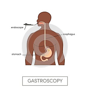 Vector gastroscopy concept