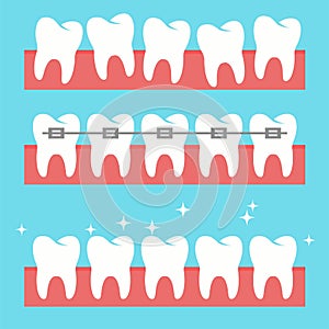 Vector healthy teeth. orthodontic tooth brace