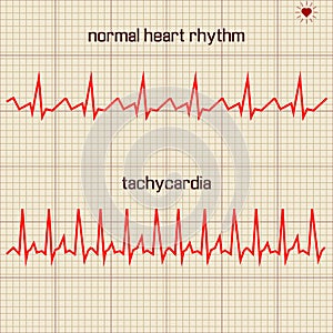Vector - Heart beats cardiogram