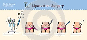 Pictórico colocar liposucción cirugía 