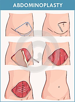 Vector illustration of a abdominoplasty and Lipectomy Procedures