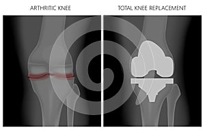 Meniscus _Arthritic knee and Total knee replacement photo