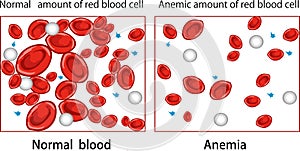 Vector illustration of a Anemia diagram photo
