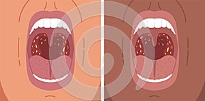 Vector illustration of bacterial tonsillitis, sore throat