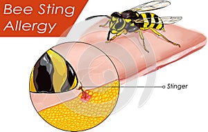 Vector illustration of a Bee sting allergy
