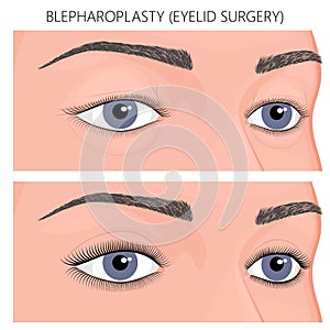 Plastic surgery_Blepharoplasty eyelid surgery photo