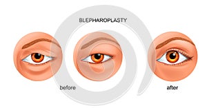 Blepharoplasty of the overhanging eyelid and Asian eyelid photo