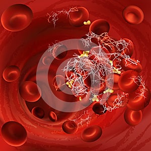 Vector illustration of a blood clot, thrombus or embolus with coagulated red blood cells, platelets in the blood vessels photo