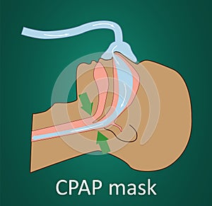 Vector illustration of breathing with CPAP mask.