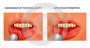 Candidiasis and aphthous stomatitis photo