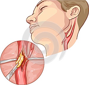 vector illustration of a Carotid Endarterectomy
