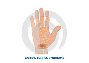 Vector illustration of carpal tunnel syndrome