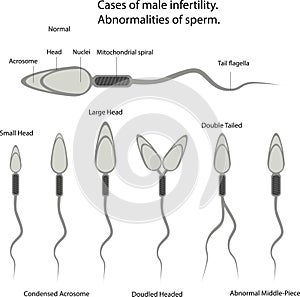 Vector illustration cases of male infertility. Abnormalities of sperm.