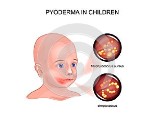 Pyoderma in child
