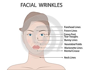 Vector Illustration of Common Types of Facial Wrinkles, cosmetic surgery, woman facial treatment concept