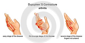 Contracture Palmar aponeurosis