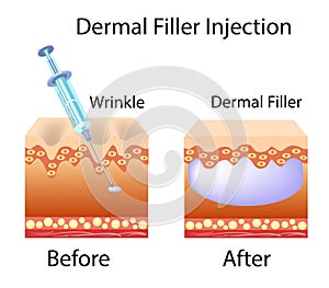 Vector illustration with cosmetic filler or Dermal fillers