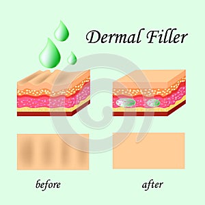 Vector illustration with cosmetic filler or Dermal fillers on green background