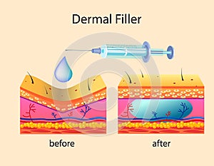 Vector illustration with cosmetic filler or Dermal fillers on light background