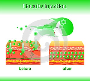 Vector illustration with cosmetic filler or Hyaluronic acid on light background