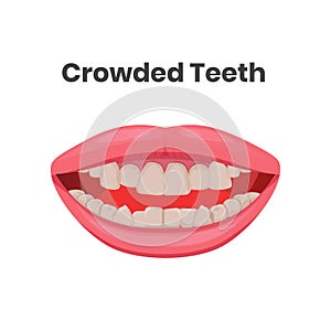 Vector illustration of the crowded, yellow teeth