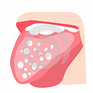 Vector illustration. Dry throat as a sign to commemorate Sjogrens day. on a white background.