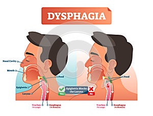 Vector illustration about dysphagia. Human scheme with nasal cavity, mouth, tongue, epiglottis, larynx, trachea and esophagus.