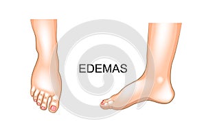 Foot swelling. edema photo